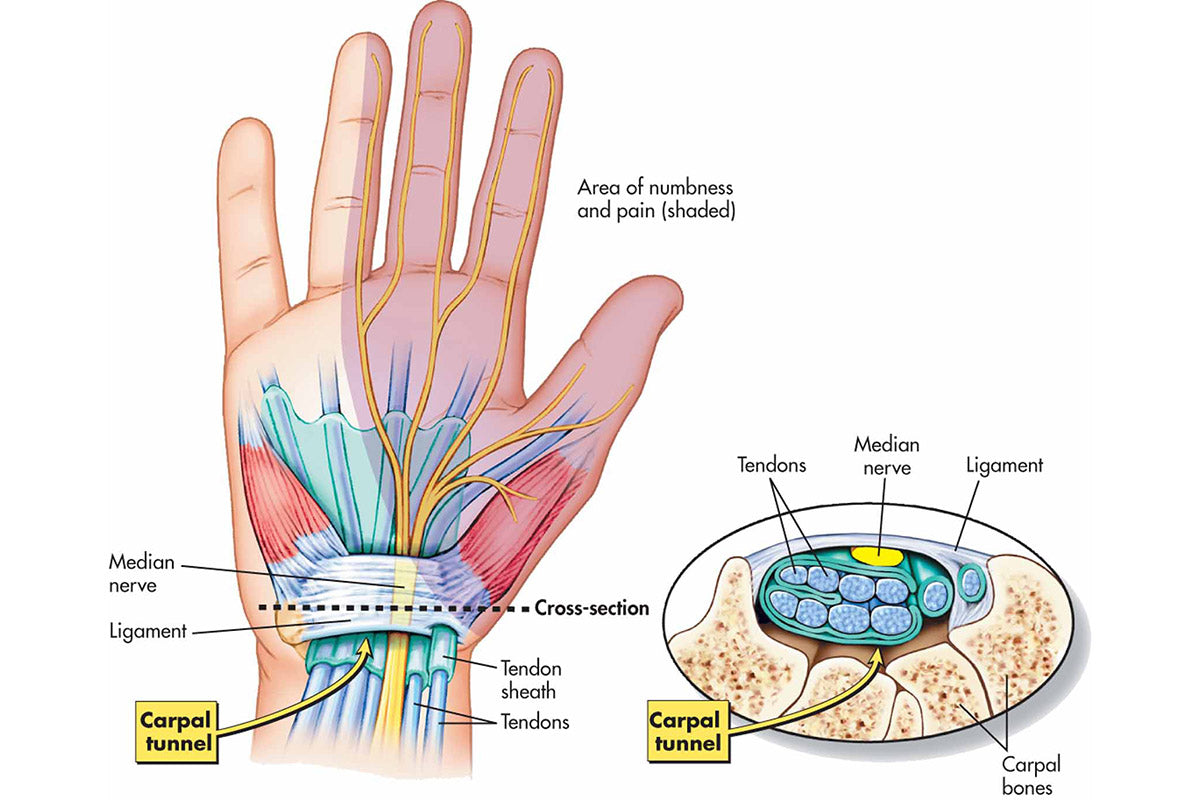 Tìm hiểu về hội chứng ống cổ tay (CTS).